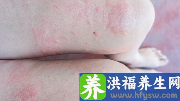 小儿疱疹性咽峡炎反复发烧怎么回事
