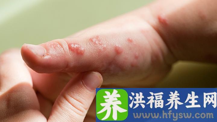 汗疱疹怎么治疗除根