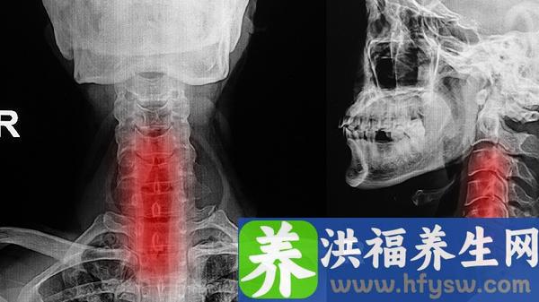 咽喉长疱疹是什么原因引起的