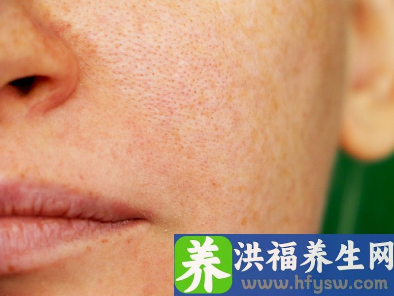 毛孔粗大黑头很多该怎么办 毛孔粗大可以用激光治疗吗 ？