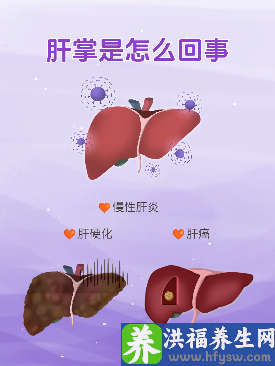肝掌是怎么回事？解析在此