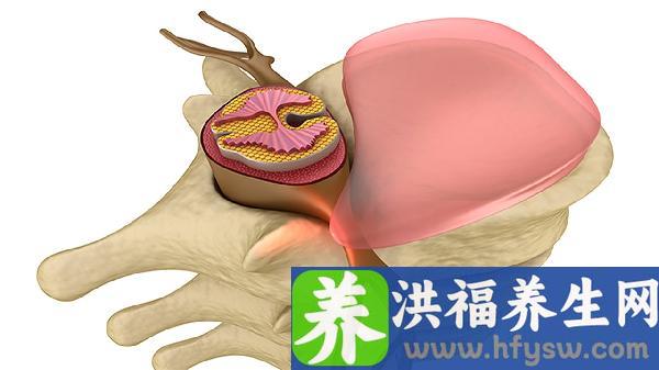 梨状肌压迫坐骨神经痛做手术松解