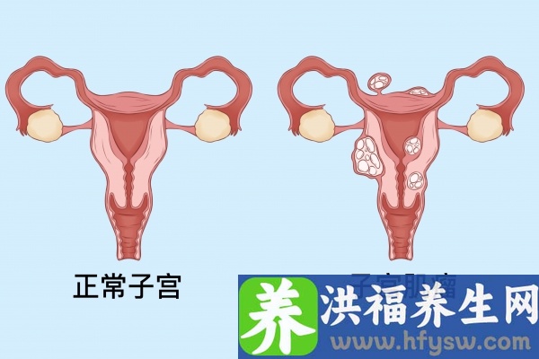 子宫肌瘤可以吃桂圆吗