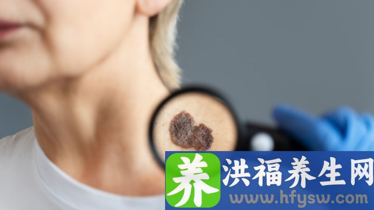 垂体瘤术后尿崩怎么了