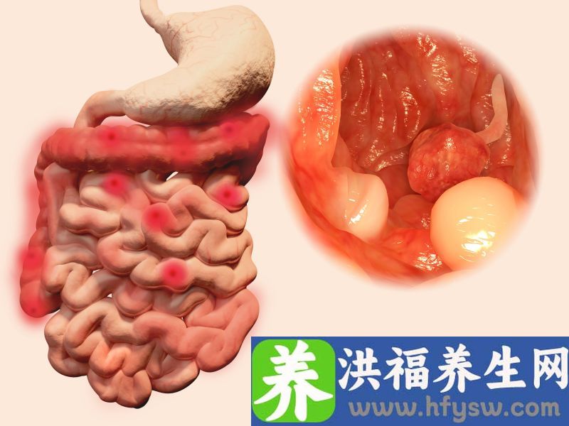 肠息肉的症状表现