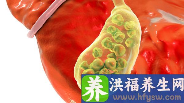 女性结石卡在输尿管里掉不下来怎么办