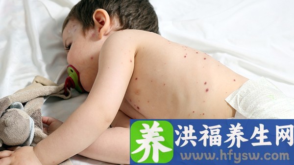 儿童肾病能做2项运动 预防儿童肾病有什么方法