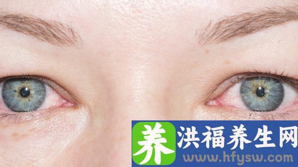 春季结膜炎如何缓解？5种眼药水使用指南，医生建议这样做！