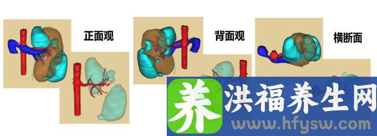 高中女生突发腰腹痛竟是巨大肿瘤破裂出血，中山一专家施妙手摘瘤保肾