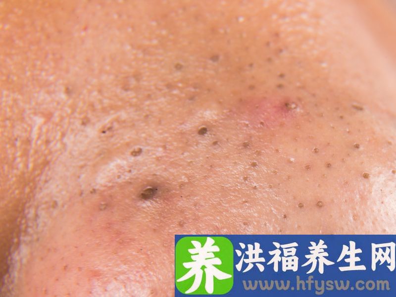 去黑头的有效方法