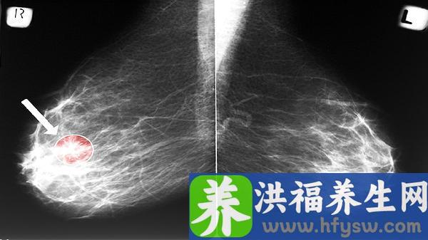 肾上腺疾病包括肾上腺肿瘤吗