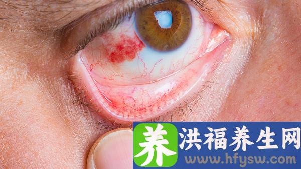 疱疹角膜炎怎么治疗