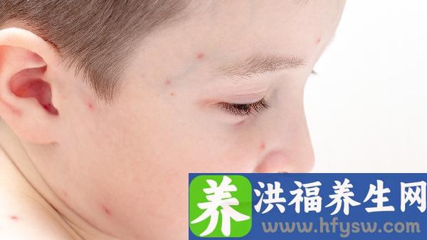 春季婴幼儿皮肤过敏怎么办？5种有效治疗方法全解析