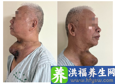 老伯忽略甲状腺乳头状癌的治疗致晚期，医生精准治疗获新生
