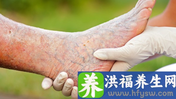 2型糖尿病对胎儿影响因素