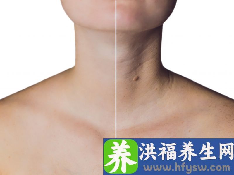 脖子的颈纹和额头川字纹该如何去除