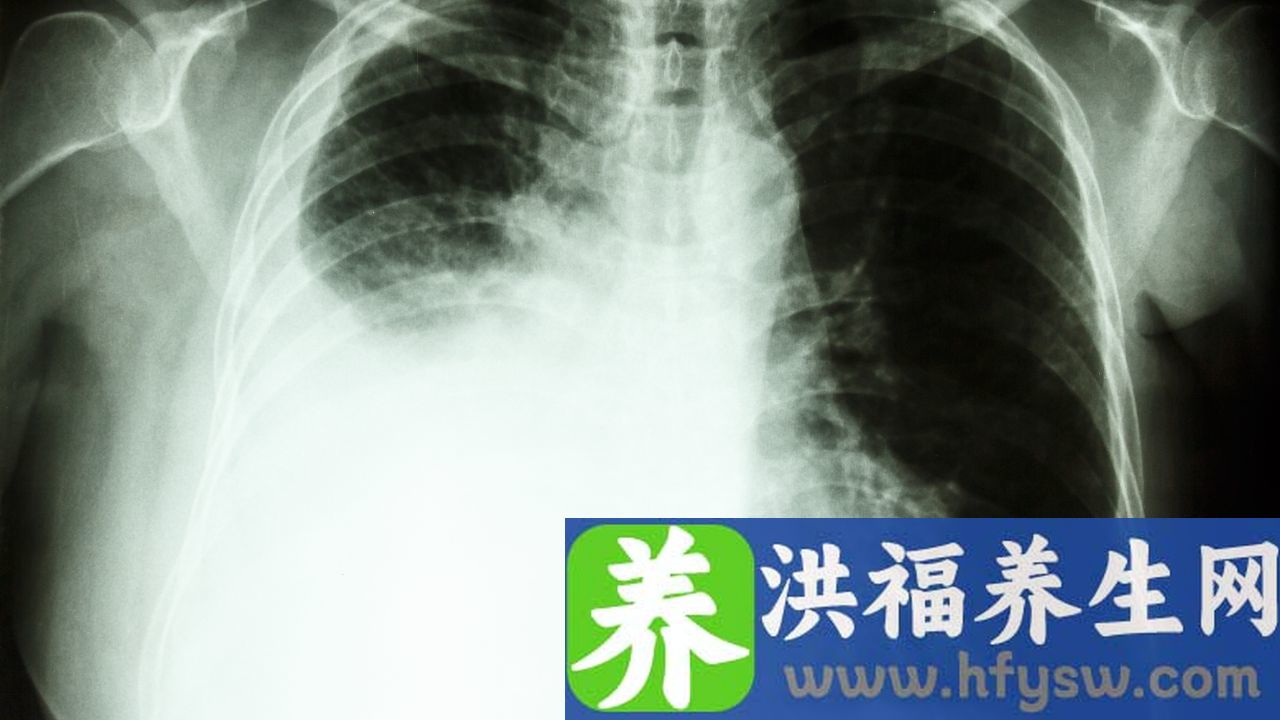 胸腔积液是由哪些原因导致的
