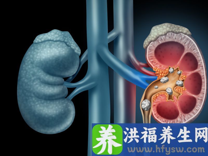 人为什么容易患上肾结石？除了不爱喝水，一般还和这两点有关系