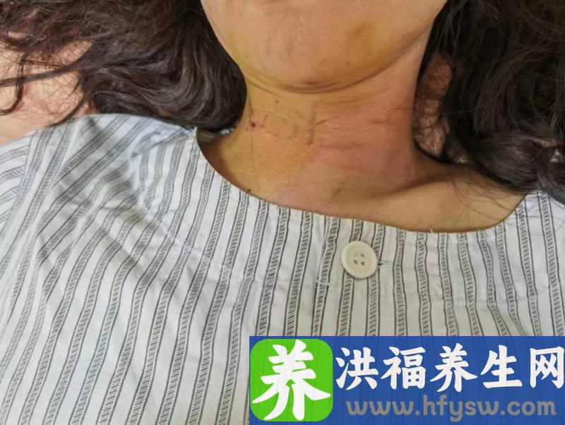 专家给甲状腺手术“开新路”:不留明显疤痕，也无术后肿胀！