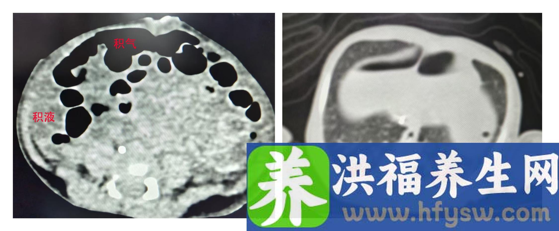 出生3天早产儿突发高热腹胀，竟是因为这个地方漏了口