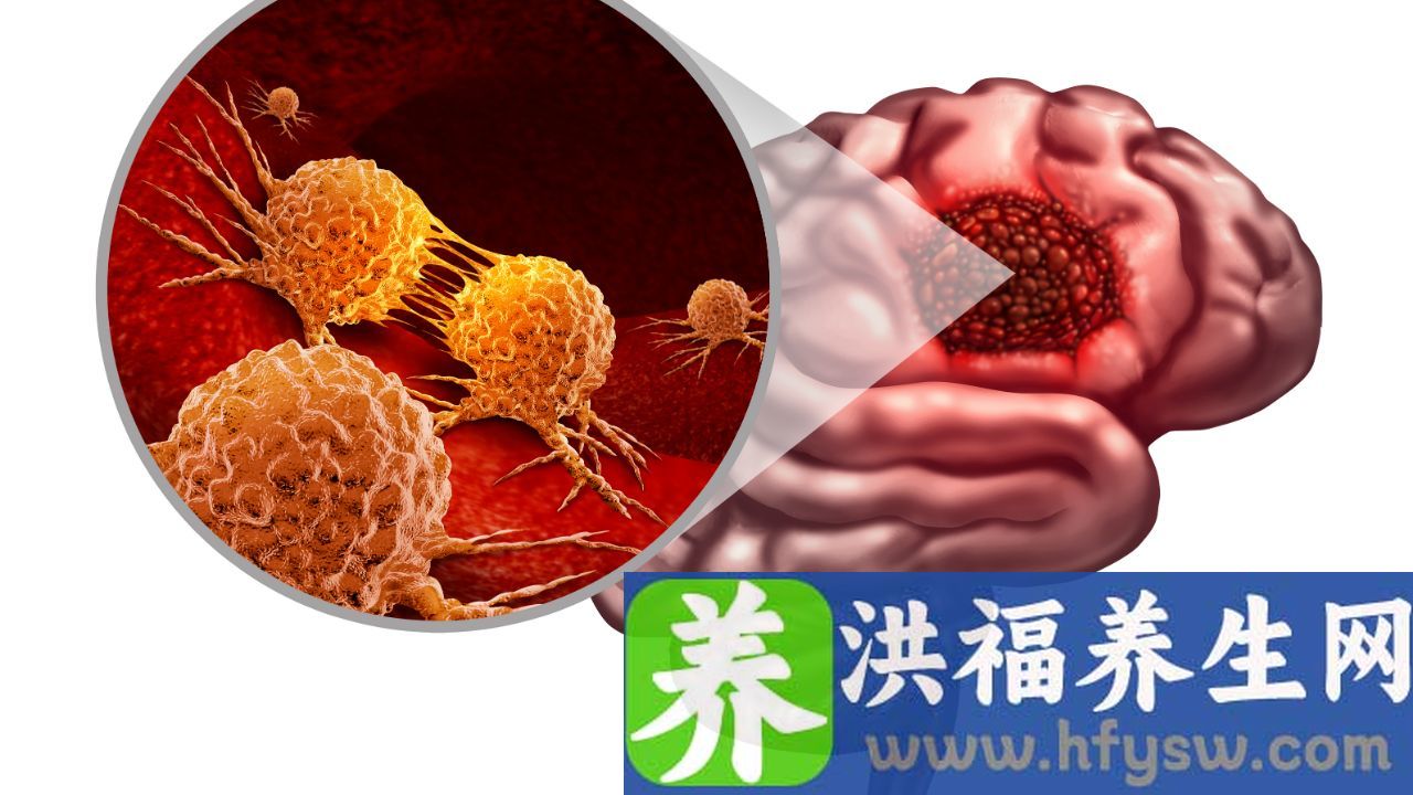 脑胶质瘤4级能治愈吗