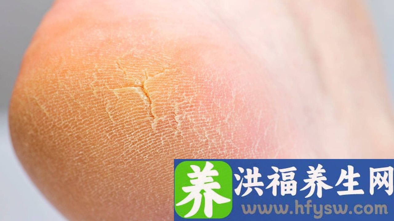 脚后跟痛如何治疗
