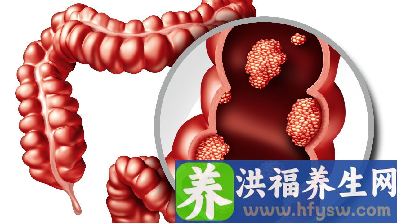 肠结核的症状