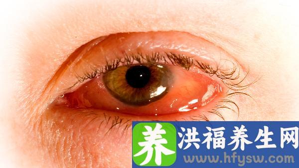 春季结膜炎高发？3招护眼秘诀帮你远离眼红、眼痒困扰