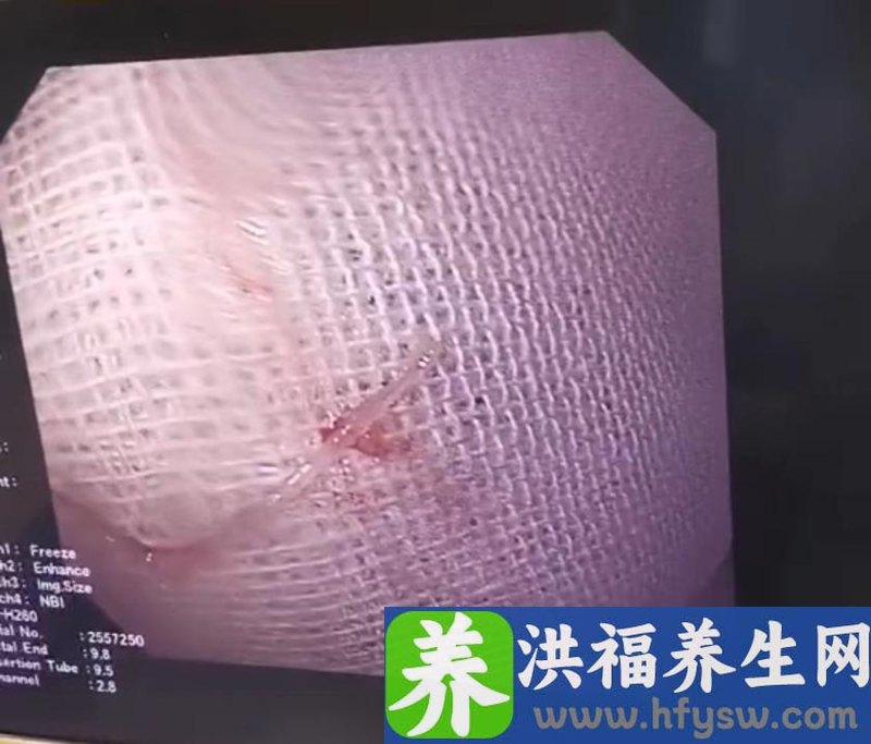 封控区一女子喉咙“遇刺”10小时，医护人员巧手取出