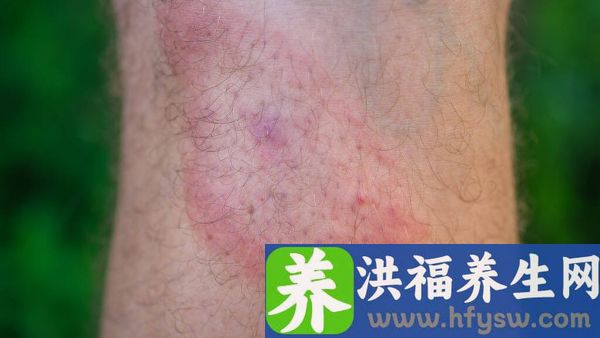 系统性红斑狼疮能吃杨梅吗