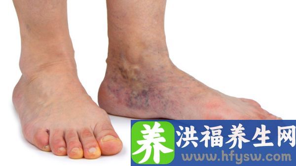 脚侧凸起硬骨但没有感觉到是怎么回事
