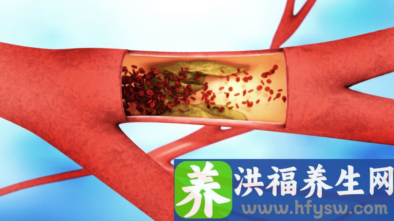 动脉粥样硬化能恢复正常吗