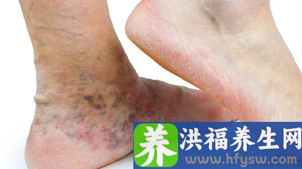 风湿痹症有哪些症状