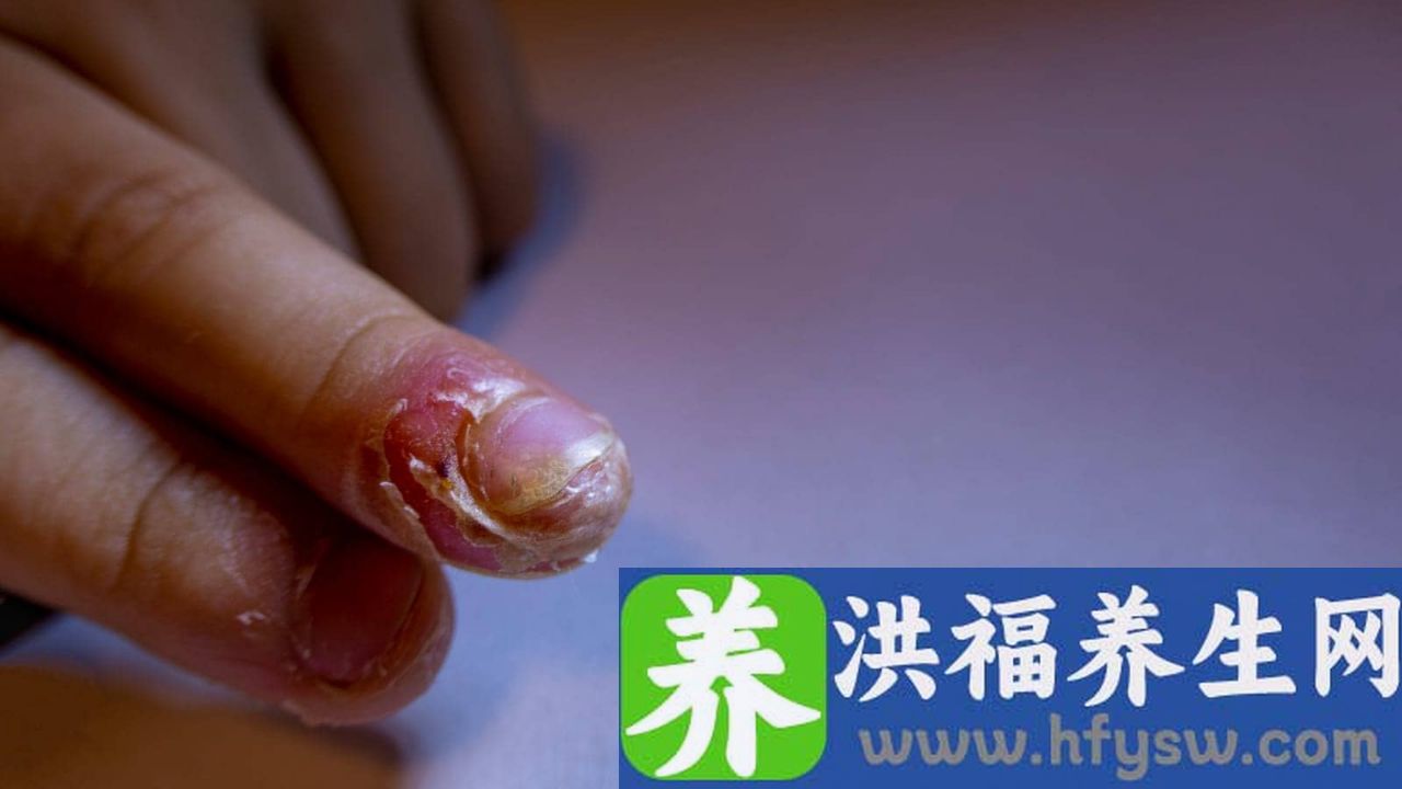 真菌感染症状