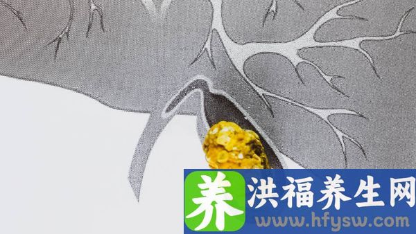胆囊结石会癌变吗