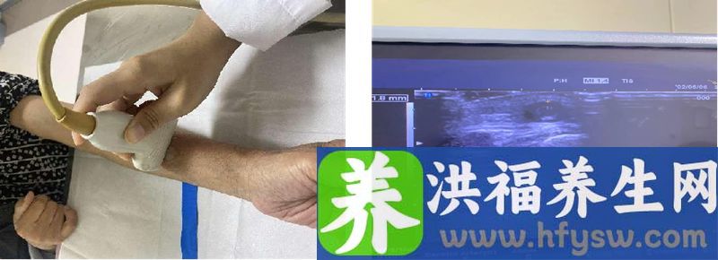 血透患者内瘘堵塞怎么办？记住这“八个好”！