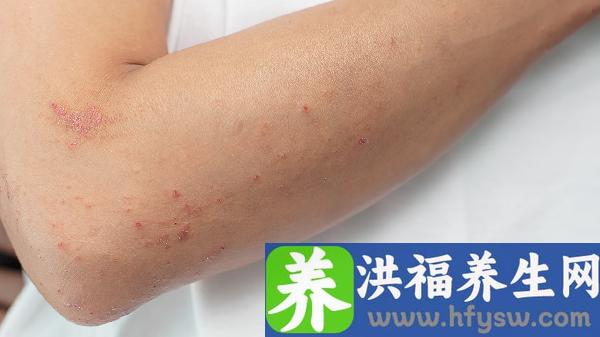 干燥综合症是什么症状