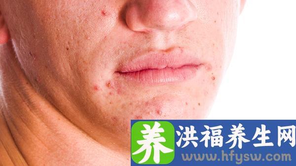 过敏性紫癜再次复发怎么办能治好吗