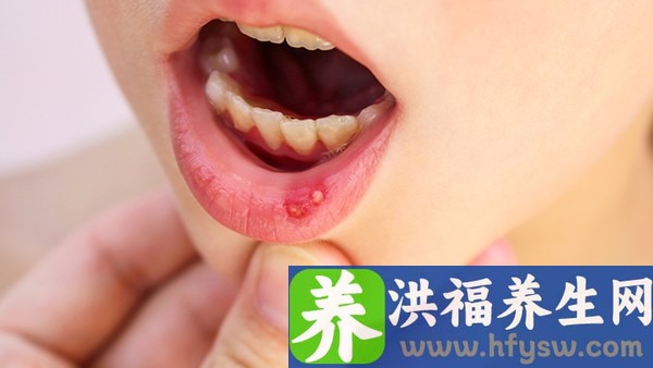 口腔溃疡的早期症状是怎样的？口腔溃疡吃什么药好得快