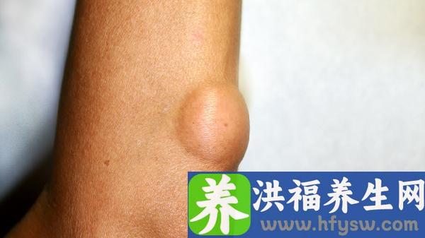皮肤软纤维瘤会癌变吗严重吗能治好吗