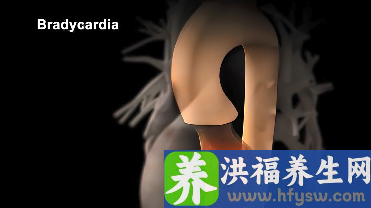 肥厚型心肌病临床表现