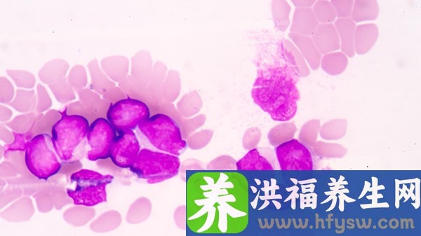 感染hpv为什么要跳绳? hpv感染白带图片