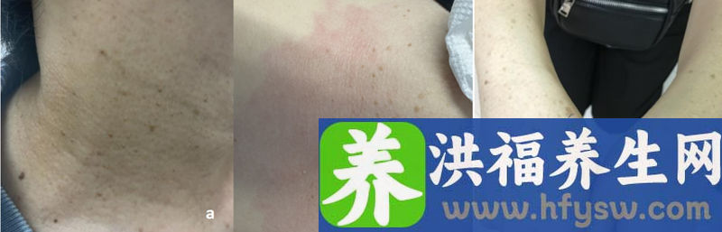脸和脖子长了“小肉粒”是“疣”吗？皮肤科医生：通常不是，激光可祛除！