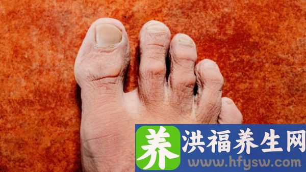 脚趾头变紫是骨折了吗