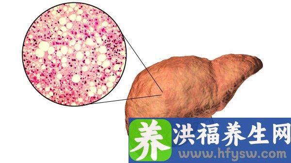 肝硬化腹水能吃什么食物
