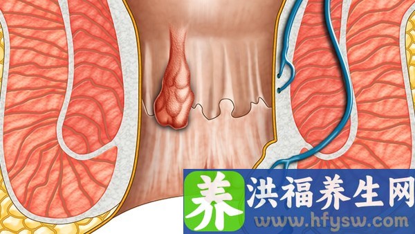 什么是高钾血症