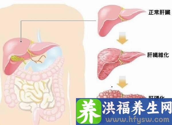 肝硬化能吃什么水果？柠檬效果居然那么大