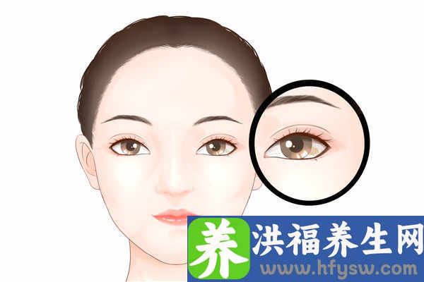 脸上起老年斑怎样去除