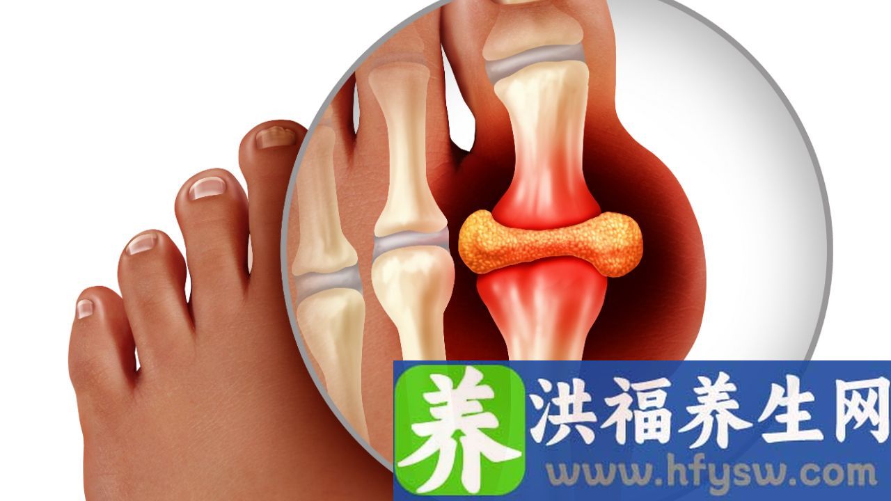 尿酸高生活中应该多注意些什么