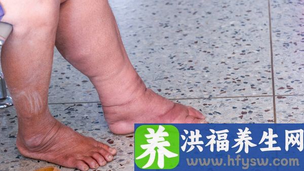 高原反应脚肿正常吗
